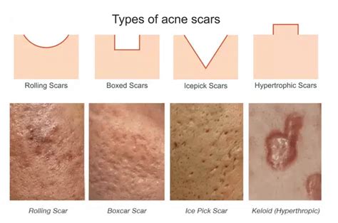 boni scars|5 Types of Acne Scars and How to Treat Them